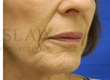 Collagen Induction Therapy Before & After Patient #305
