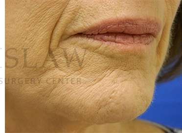Collagen Induction Therapy Before & After Patient #305