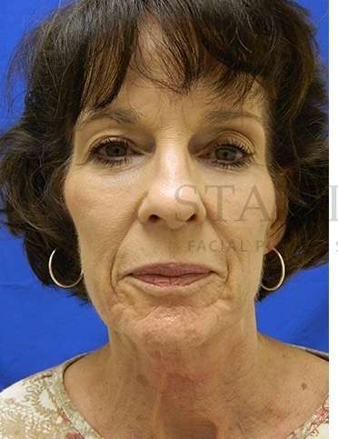Collagen Induction Therapy Before & After Patient #305