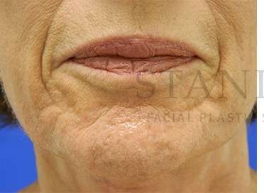 Collagen Induction Therapy Before & After Patient #305