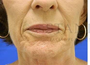 Collagen Induction Therapy Before & After Patient #305