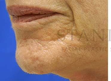 Collagen Induction Therapy Before & After Patient #305