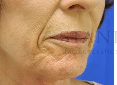 Collagen Induction Therapy Before & After Patient #305