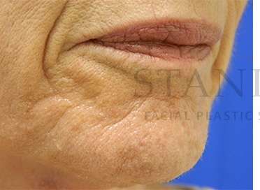 Collagen Induction Therapy Before & After Patient #305
