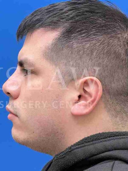 Earlobe Reduction Before & After Patient #346