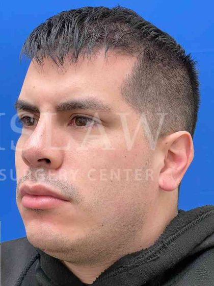 Earlobe Reduction Before & After Patient #346