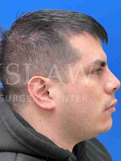 Earlobe Reduction Before & After Patient #346