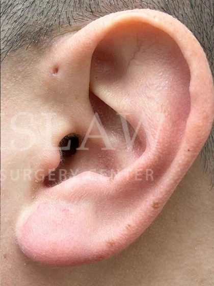 Earlobe Reduction Before & After Patient #346