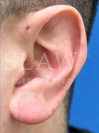 Earlobe Reduction Before & After Patient #346