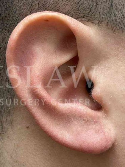Earlobe Reduction Before & After Patient #346