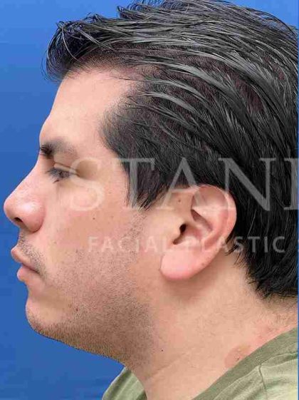Earlobe Reduction Before & After Patient #346