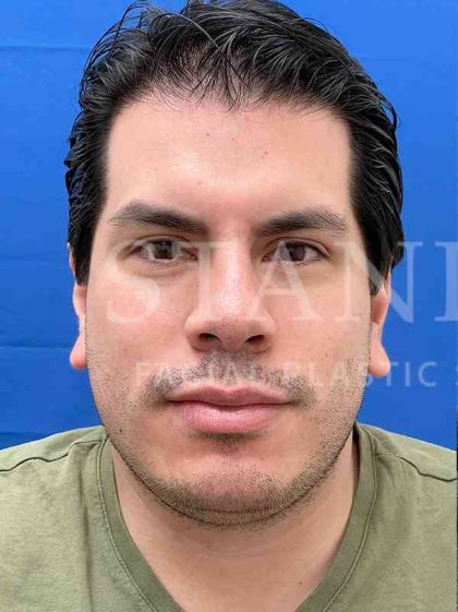 Earlobe Reduction Before & After Patient #346