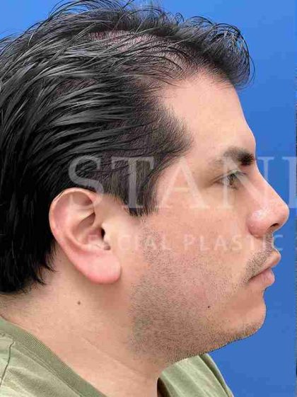 Earlobe Reduction Before & After Patient #346