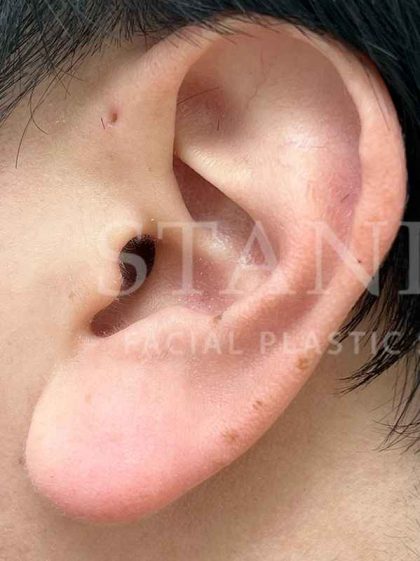 Earlobe Reduction Before & After Patient #346