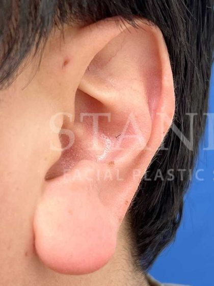 Earlobe Reduction Before & After Patient #346