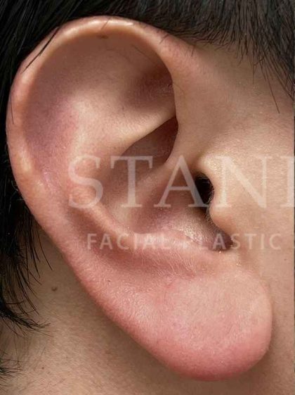 Earlobe Reduction Before & After Patient #346