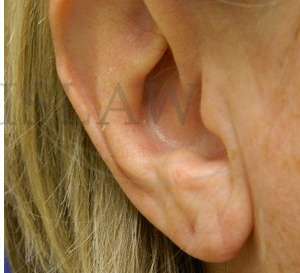 Earlobe Reduction Before & After Patient #355