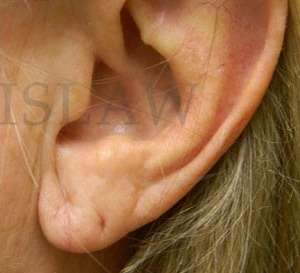 Earlobe Reduction Before & After Patient #355