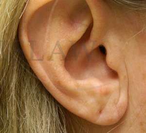 Earlobe Reduction Before & After Patient #355