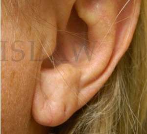 Earlobe Reduction Before & After Patient #355