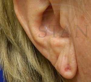 Earlobe Reduction Before & After Patient #355