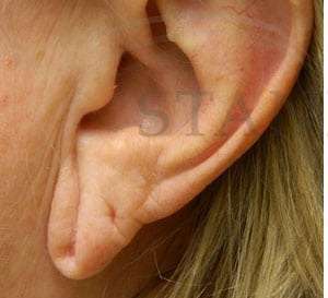 Earlobe Reduction Before & After Patient #355
