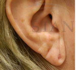 Earlobe Reduction Before & After Patient #355