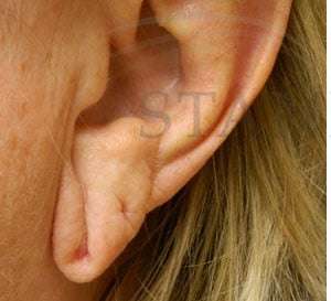 Earlobe Reduction Before & After Patient #355