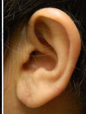 Earlobe Repair Before & After Patient #434