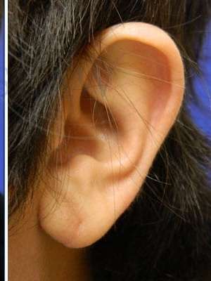 Earlobe Repair Before & After Patient #434