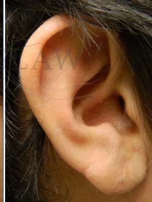 Earlobe Repair Before & After Patient #434