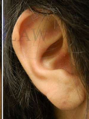Earlobe Repair Before & After Patient #434