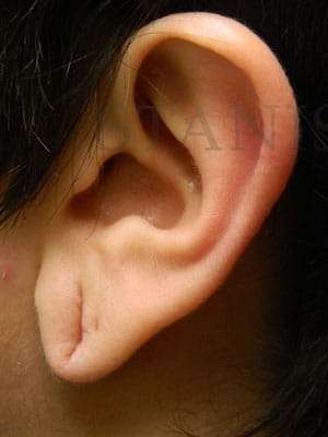 Earlobe Repair Before & After Patient #434