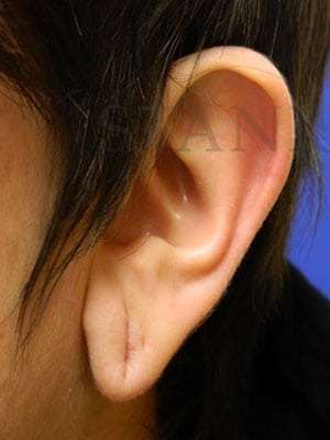 Earlobe Repair Before & After Patient #434