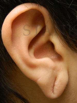 Earlobe Repair Before & After Patient #434