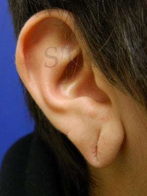 Earlobe Repair Before & After Patient #434