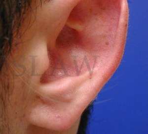 Earlobe Repair Before & After Patient #425
