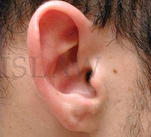 Earlobe Repair Before & After Patient #425