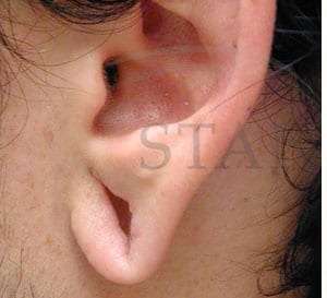 Earlobe Repair Before & After Patient #425