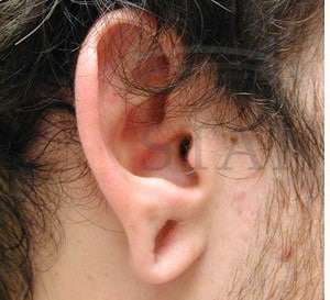 Earlobe Repair Before & After Patient #425