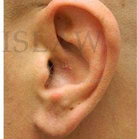 Earlobe Repair Before & After Patient #420