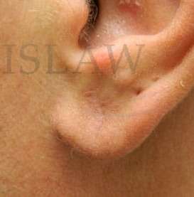 Earlobe Repair Before & After Patient #420
