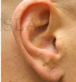 Earlobe Repair Before & After Patient #420