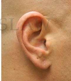 Earlobe Repair Before & After Patient #420