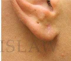 Earlobe Repair Before & After Patient #420
