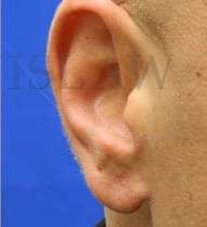 Earlobe Repair Before & After Patient #420
