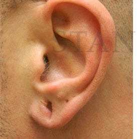 Earlobe Repair Before & After Patient #420