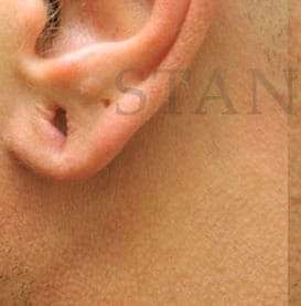 Earlobe Repair Before & After Patient #420