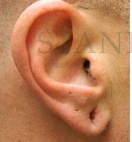 Earlobe Repair Before & After Patient #420