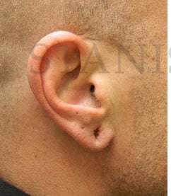 Earlobe Repair Before & After Patient #420